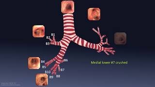 Bronchial Breath Sounds  EMTprepcom [upl. by Ahseral]