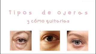 🍋  Ojeras Tipos y cómo tratarlas [upl. by Bibah621]