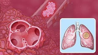 Lung cancer complications  Respiratory system diseases  NCLEXRN  Khan Academy [upl. by Bashemeth398]