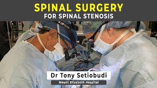 SURGERY FOR SPINAL STENOSIS [upl. by Jansen]