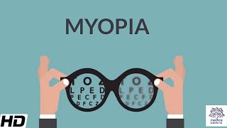 Myopia Signs and Symptoms Causes Diagnosis and Treatment [upl. by Oicnerual]