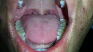 Tongue Fasciculation in MND [upl. by Lankton]