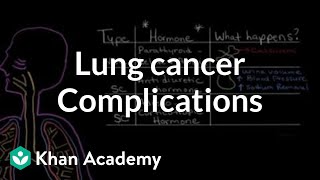 Stage 1 Lung Cancer Symptoms Treatment amp Life Expectancy  Episode 6 [upl. by Nylirehs]