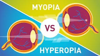 Difference between Myopia Near Sightedness amp Hyperopia FarSightedness [upl. by Htessil197]