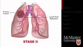 Stages of Lung Cancer [upl. by Intosh]