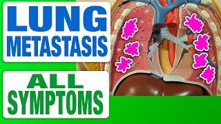 Lung Cancer Staging Presentation [upl. by Jesselyn]