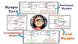 Myopia  Introduction and Etiology within 3 min 15 [upl. by Obbard148]