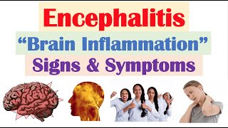 Encephalitis “Brain Inflammation” Signs and Symptoms amp Why They Occur [upl. by Adiam790]