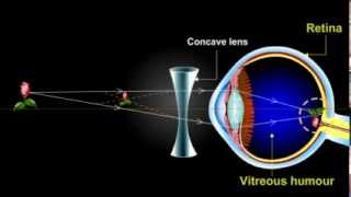 what is myopia Short Sightedness [upl. by Cower218]