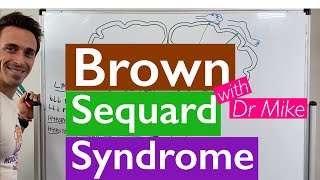 Brown Sequard Syndrome [upl. by Rubetta]