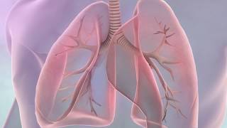 Understanding NonSmall Cell Lung Cancer [upl. by Leumhs401]