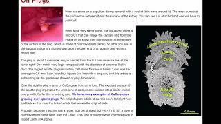 BRUSHITE STONE DISEASE [upl. by Ahsercul]